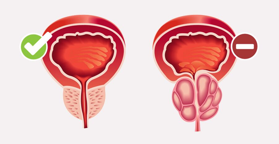 Weiprost normalizează dimensiunea și funcția prostatei